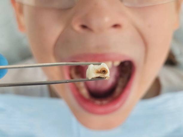 Best Emergency Dental Care for Broken or Chipped Teeth in Guin, AL